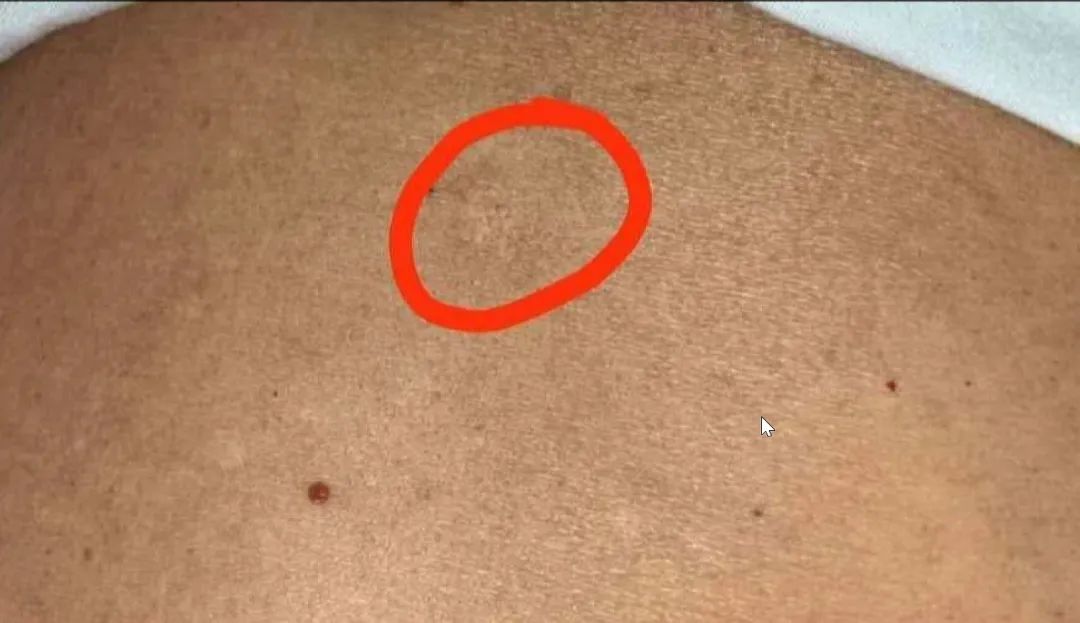 子弹铁证!85岁老人体内发现80年前日军子弹!这是一个年代的悲剧