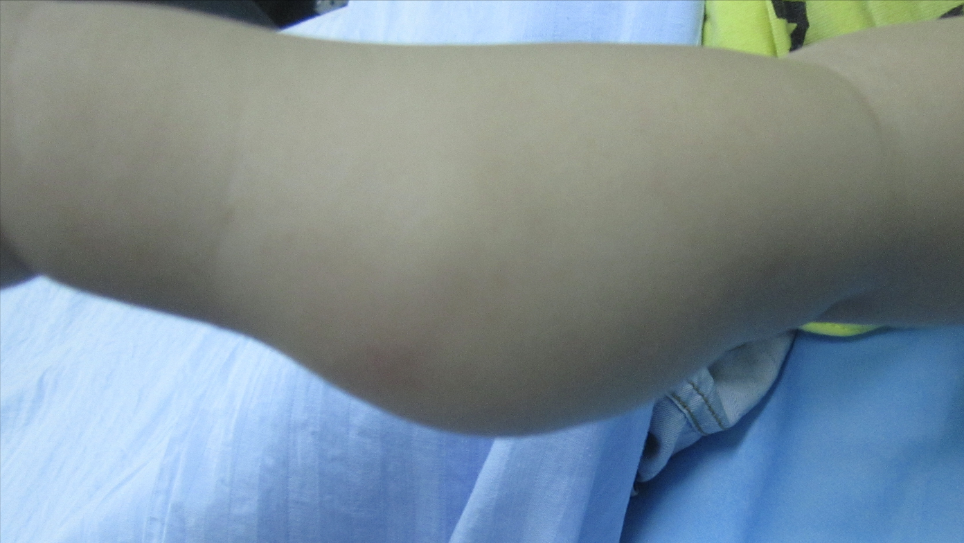 对于淋巴管畸形,应该如何治疗?