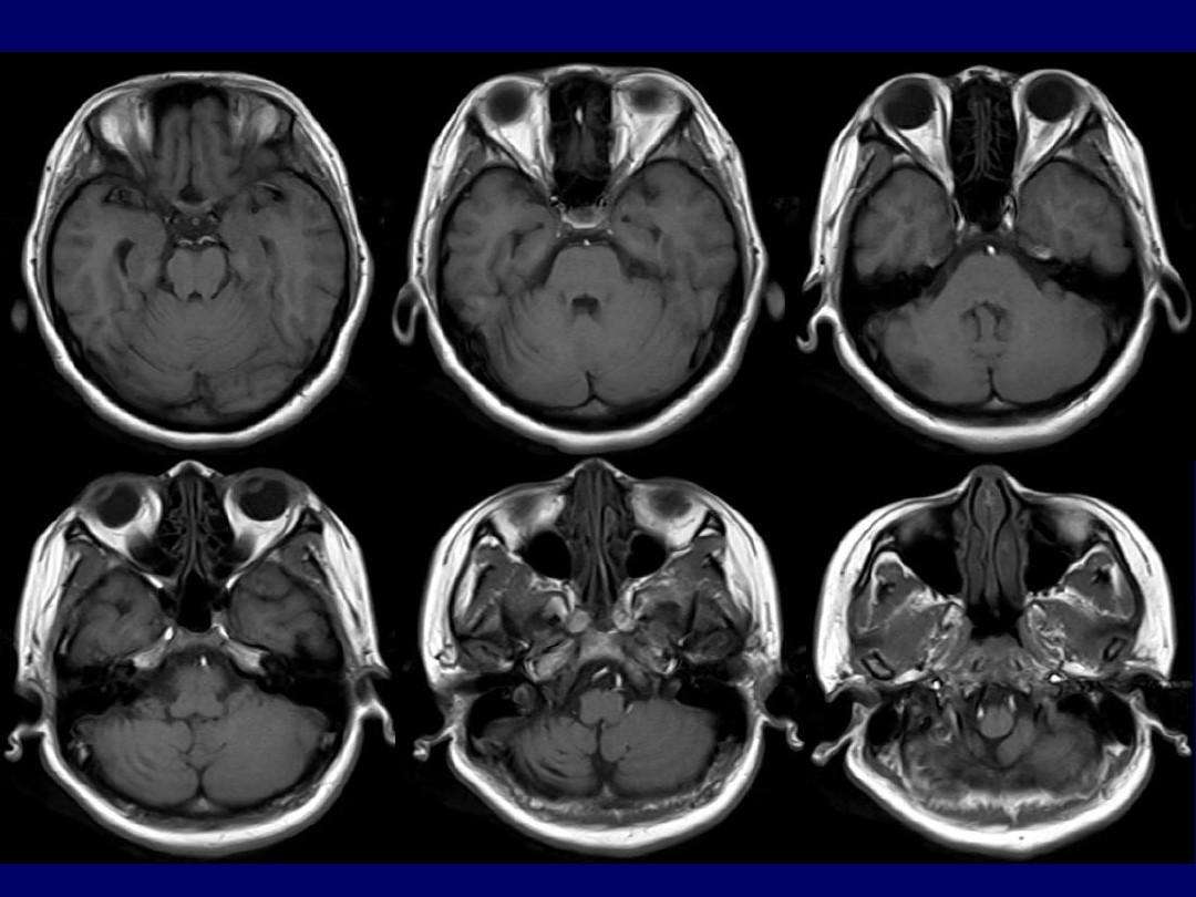 脑肺吸虫病为神经系统疾病,多由食用未煮熟食物引起