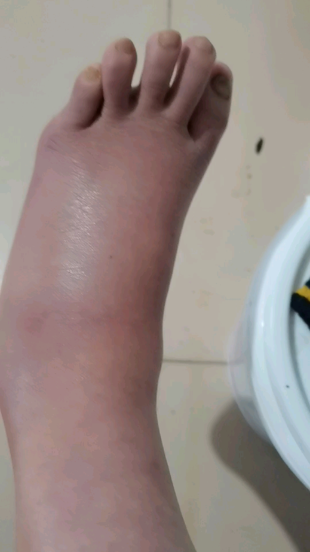 脚踝骨折第32天,肿已经消得差不多了,但淤青不散