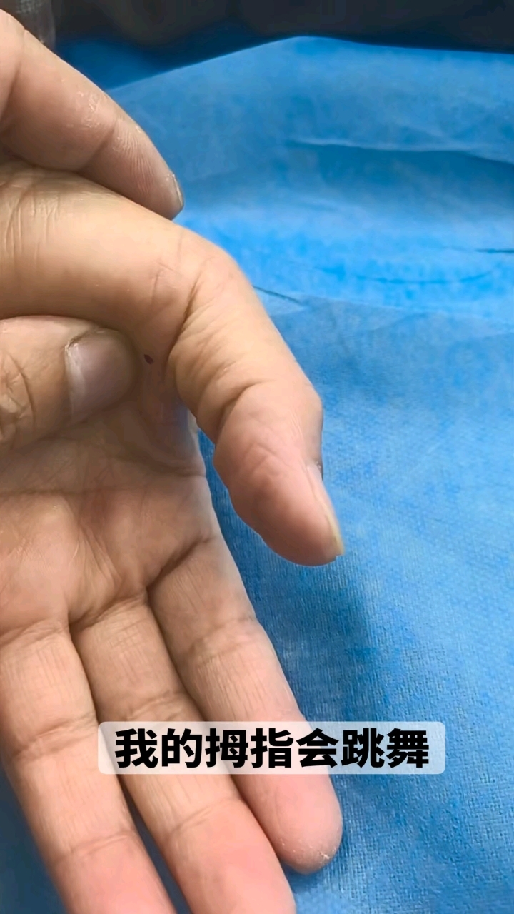 小针刀治疗腱鞘炎