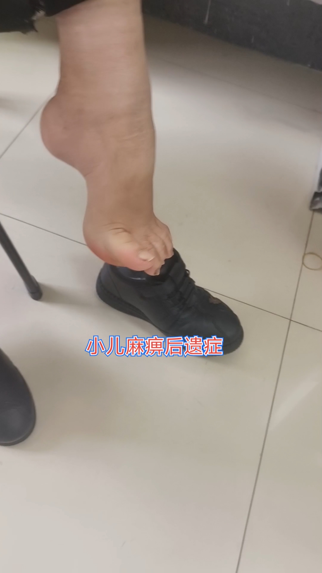 小儿麻痹后遗症导致马蹄内翻足!