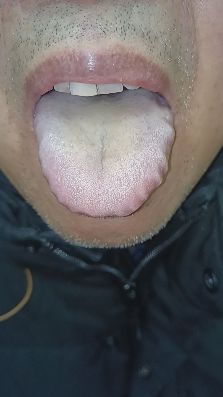 **揭秘腻苔之谜:罩黄舌边背后的故事