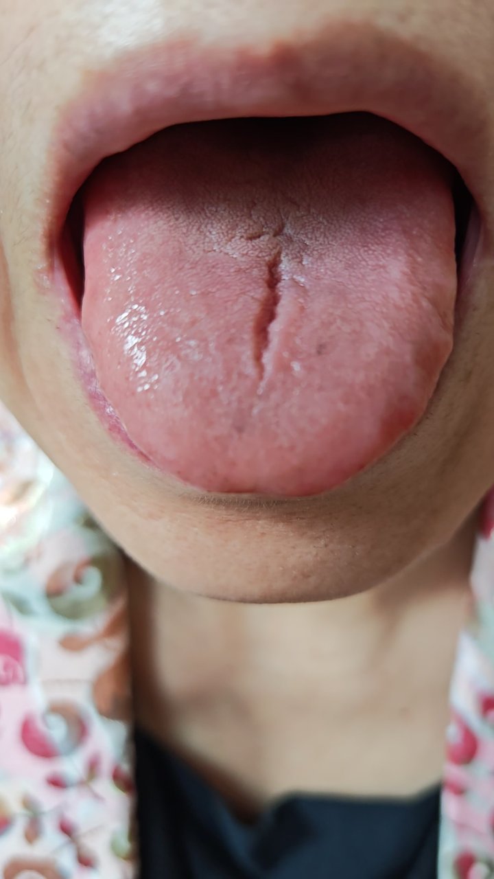 舌苔异常揭示气阴两虚之瘿病