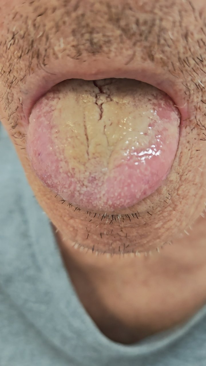 舌苔厚腻胃不适?试试化痰调理法