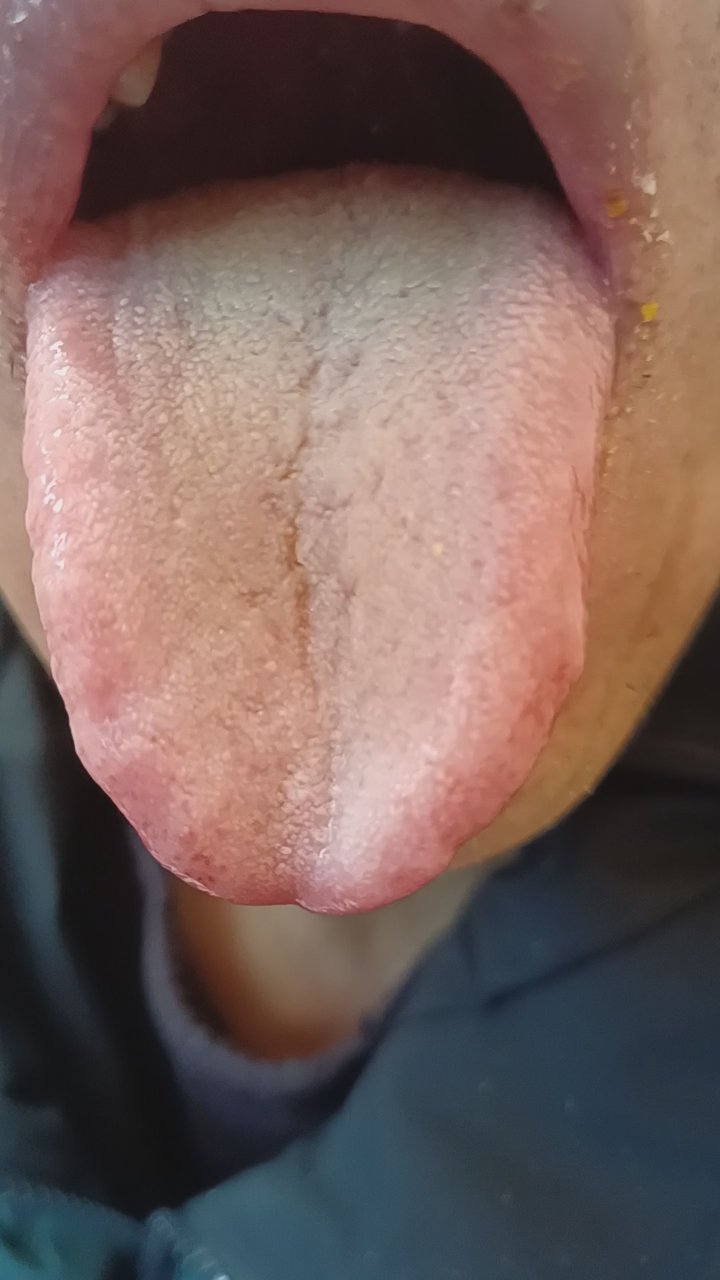 揭秘舌苔异常:慢性萎缩性胃炎信号