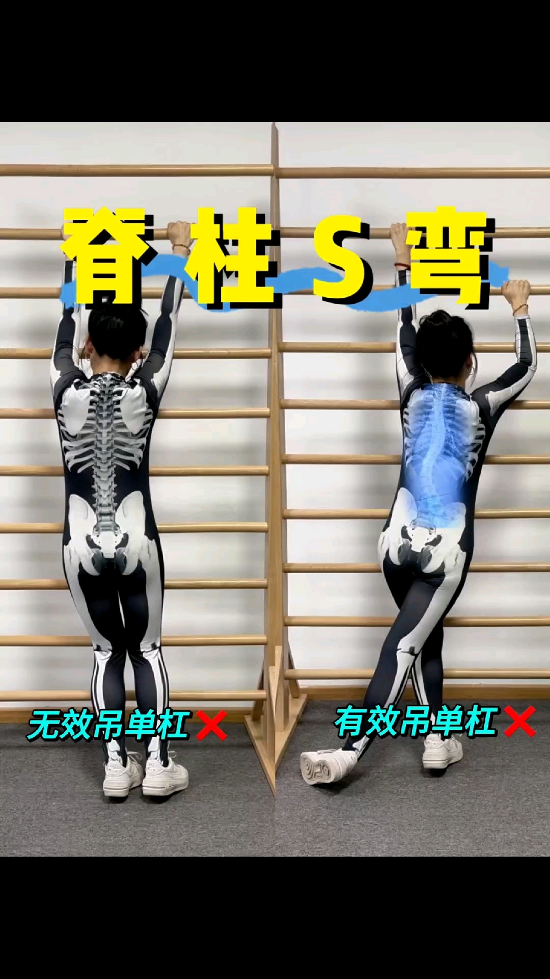矫正s型脊柱侧弯,这样吊单杠才有针对性