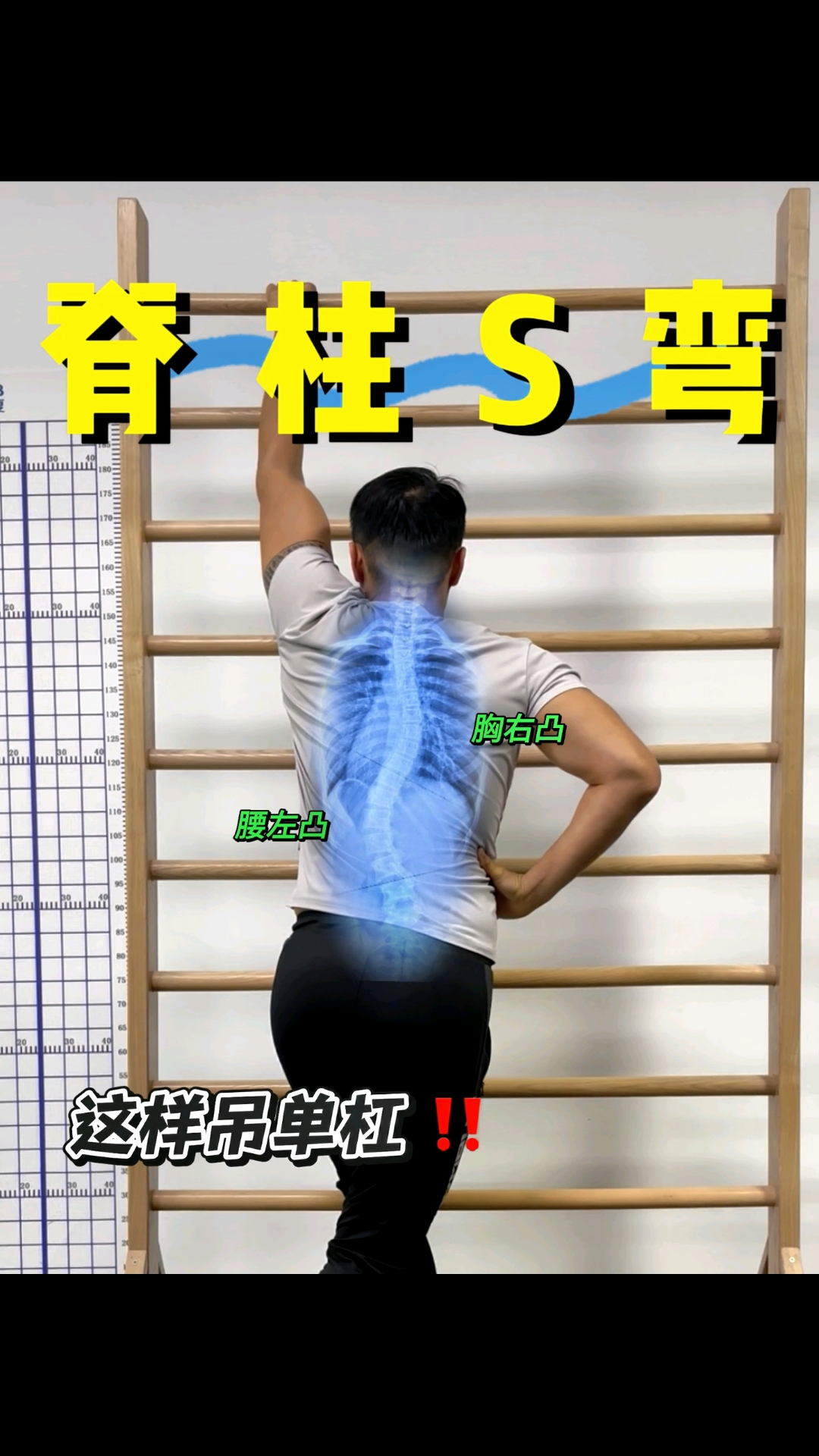 s型脊柱侧弯,这样吊单杠才有针对性