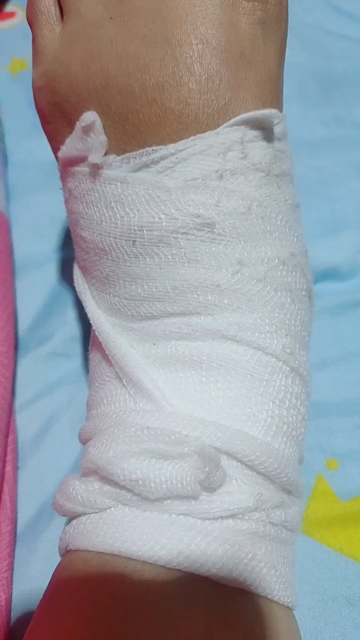 脚骨折已经6个月啦,现在走路还是很疼,昨天买膏药贴上能止疼不