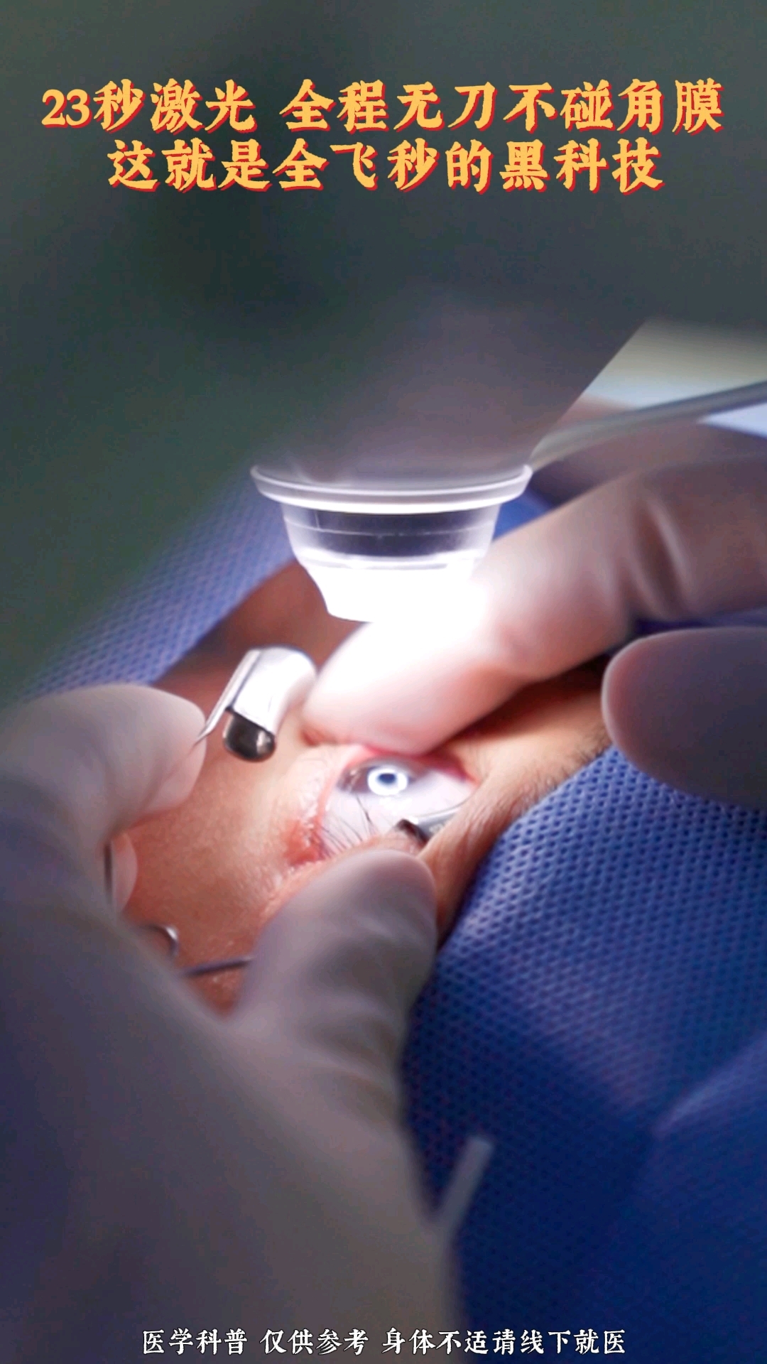全飞秒#眼科医生杨云#近视手术#全飞秒激光手术
