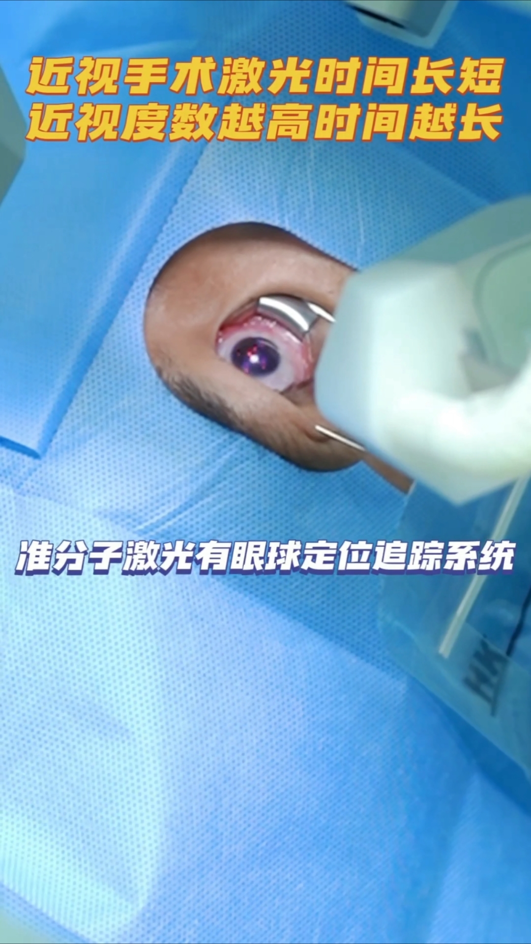 半飞秒激光手术过程,度数越高激光消融角膜时间越长