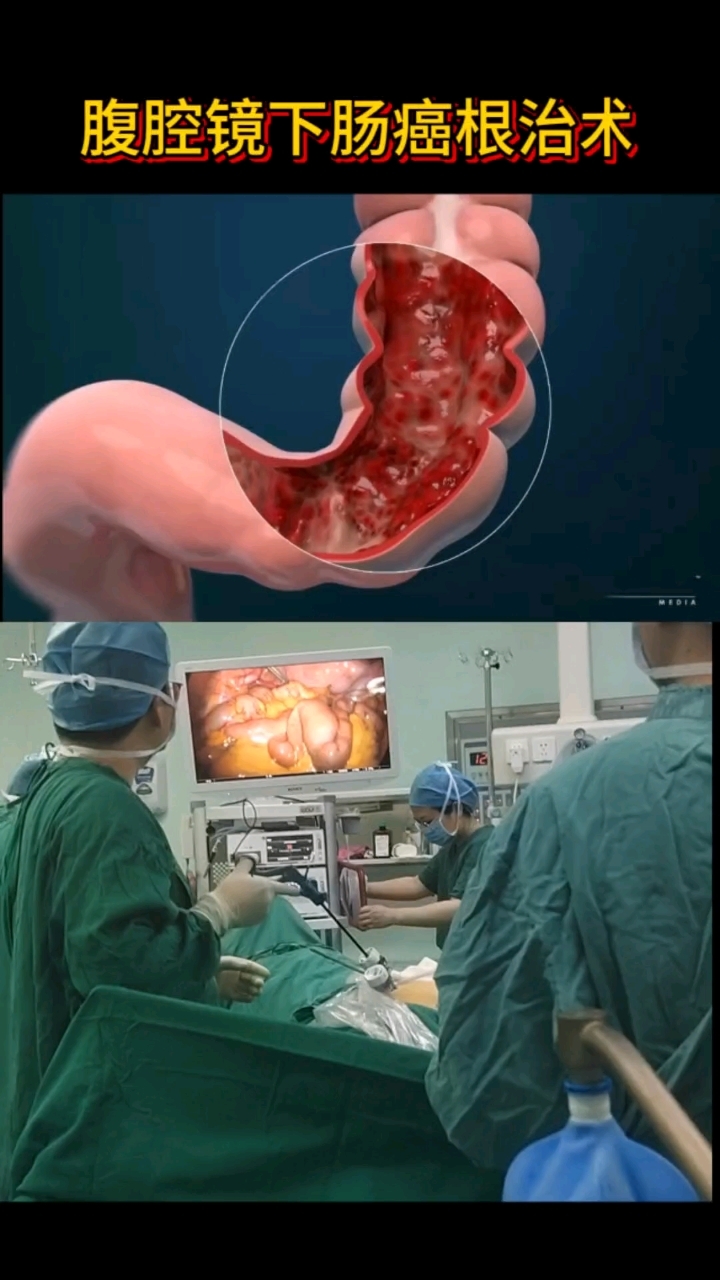 腹腔镜下肠癌根治术