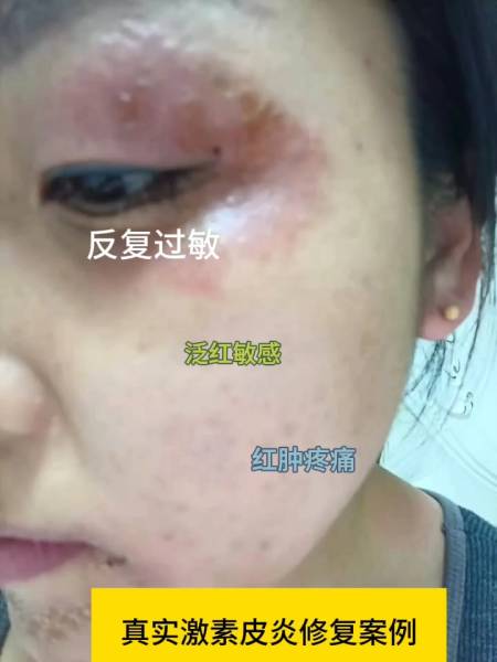 第119集真实修复激素脸案例红肿干痒反复过敏遭罪