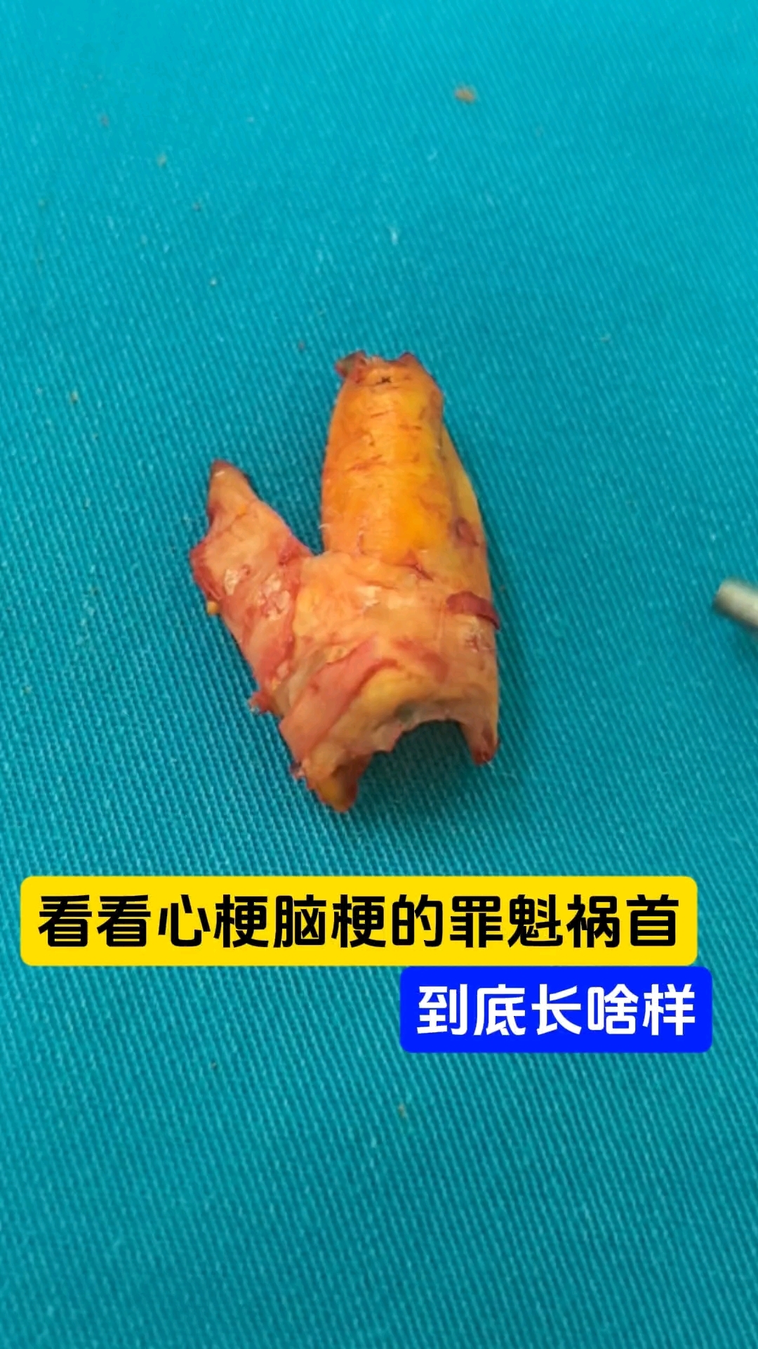 看看血管里的斑块到底长啥样