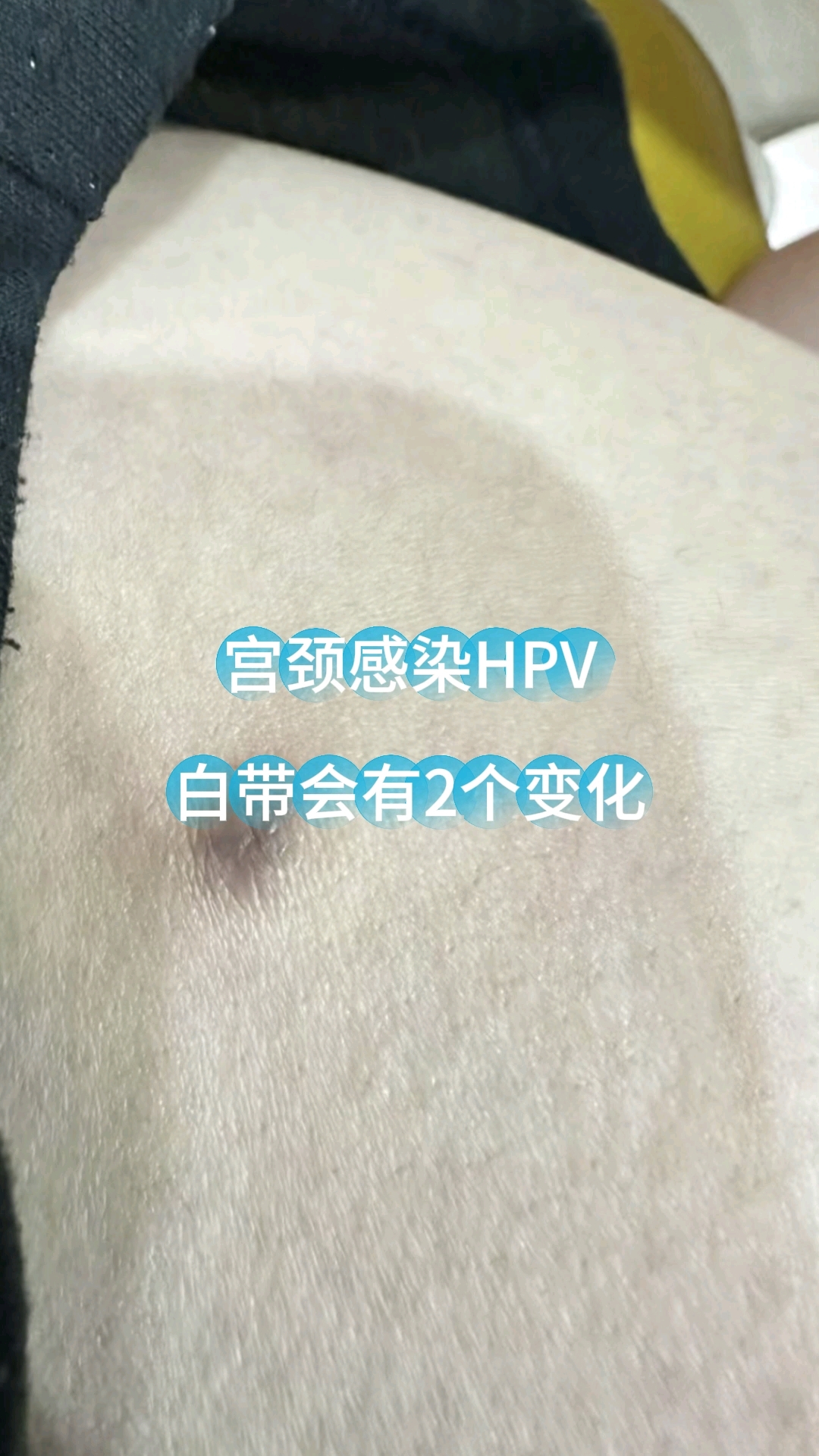 宫颈感染hpv,白带会有2个变化