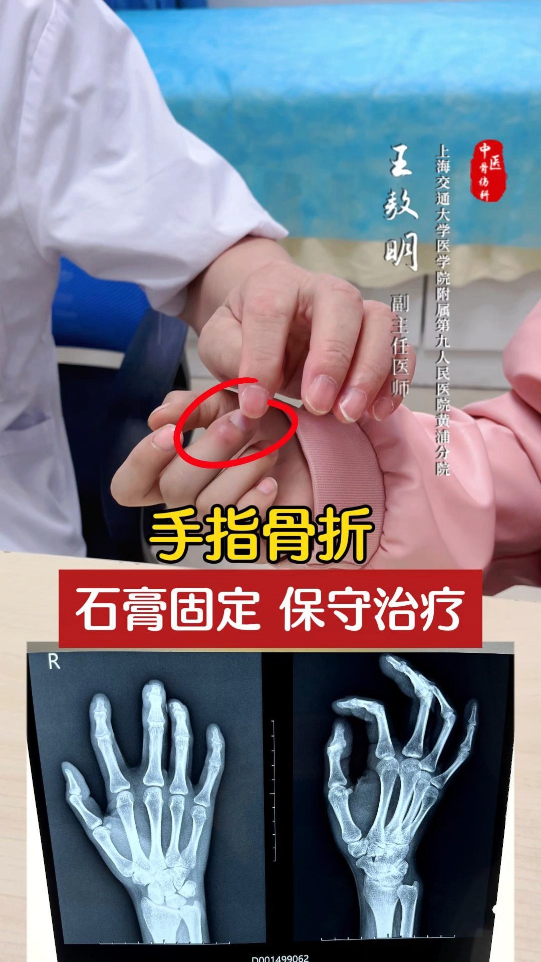【石氏伤科王敖明】手指骨折,石膏固定保守治疗!