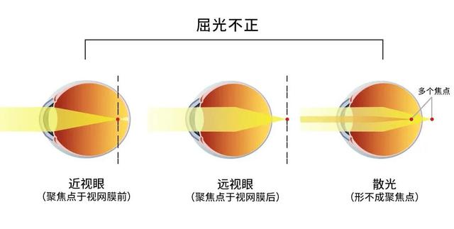 屈光不正看到的图像图片