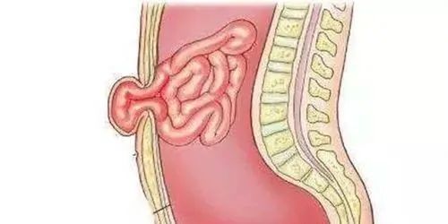 便秘引起腹部鼓包!康复者揭秘自用疗法,原来粥才是疝气克星!