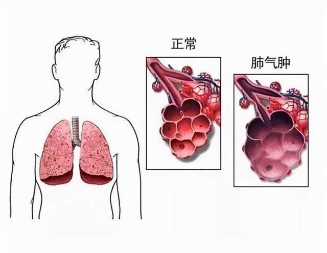 肺气泡能自愈吗 baijiahao.baidu.com