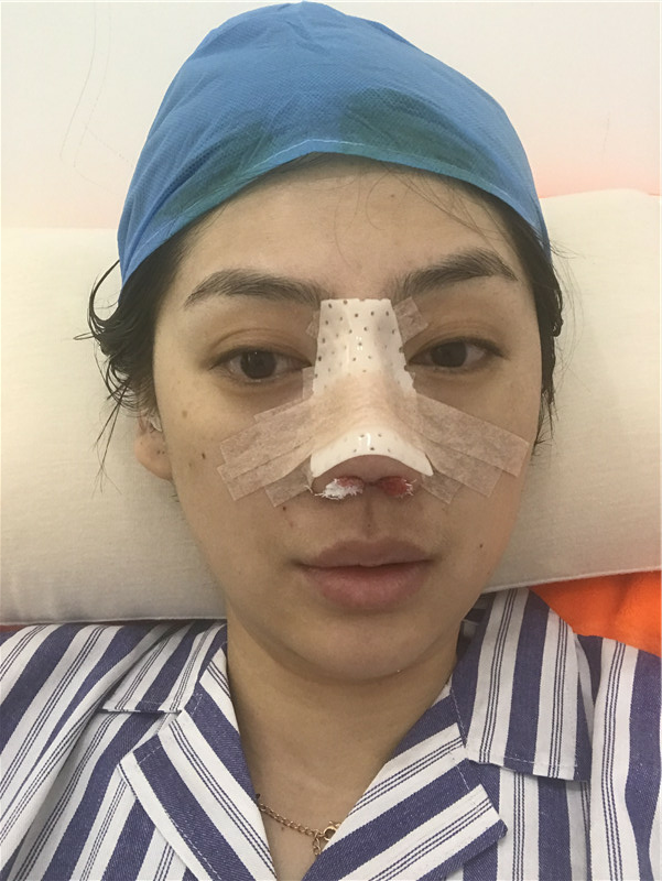 影响鼻子自体隆鼻手术费用的因素有哪些?费用包含哪些内容?