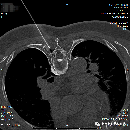 胸椎小关节紊乱症健康科普!