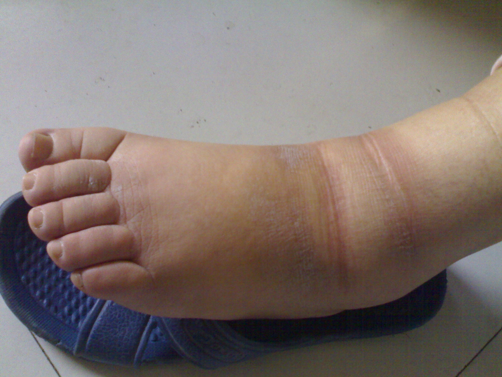 妊娠期高血压通常有哪些症状,要了解该疾病的原因及其注意事项