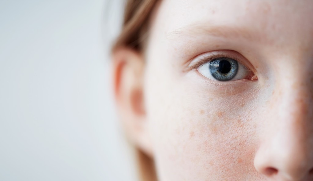 皮肤色素沉着好发于颜面部,有损容貌的美观,物理,激光治疗均可