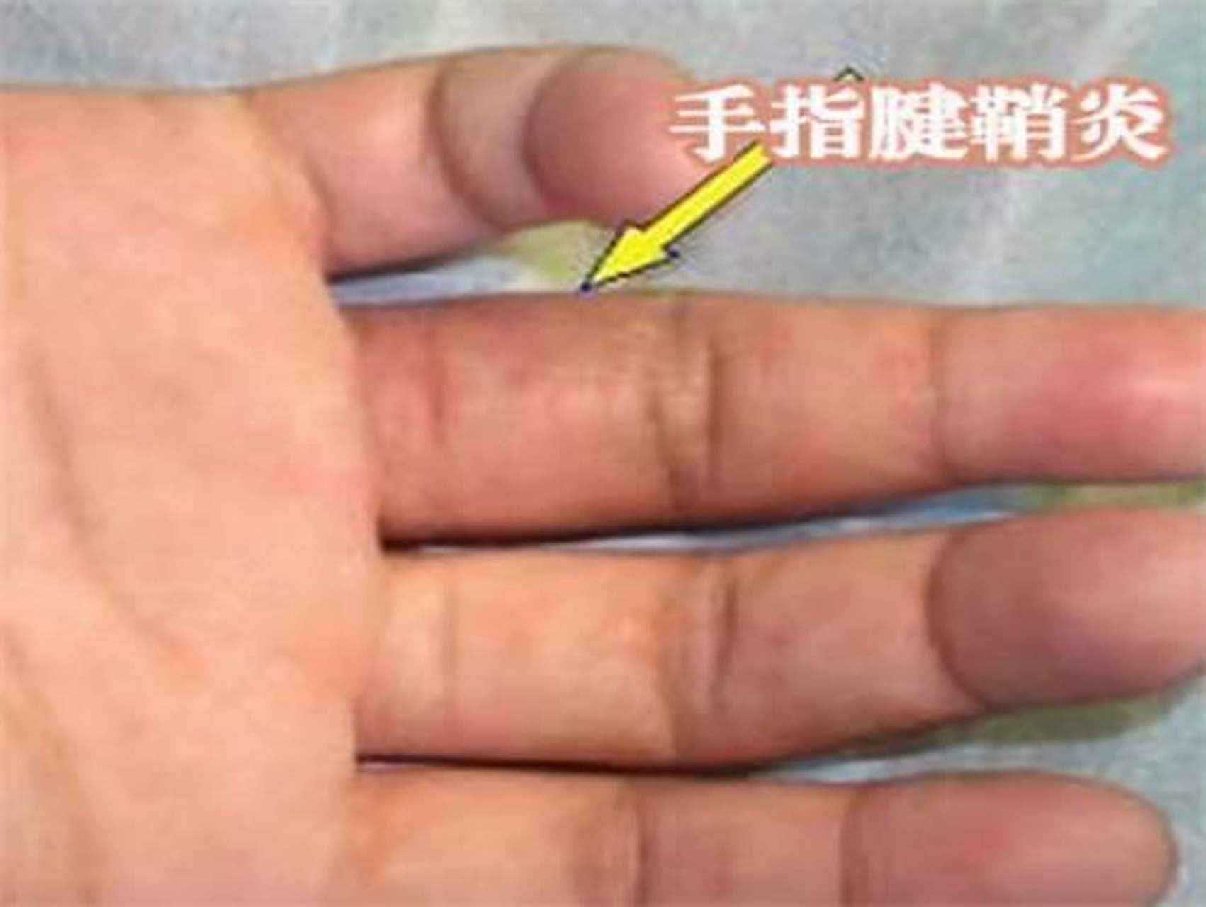 对于腱鞘炎,医生列出4种症状的具体表现,快看自己中招了没?