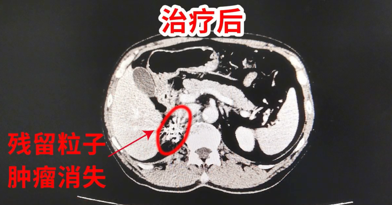 57岁男子肺癌晚期,一次粒子植入,24小时持续杀癌,肿瘤消失了!
