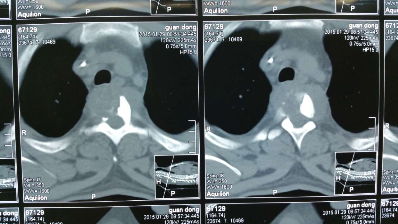 胸椎结核椎旁脓肿穿入胸腔,主要的病因是什么?临床表现有低热等