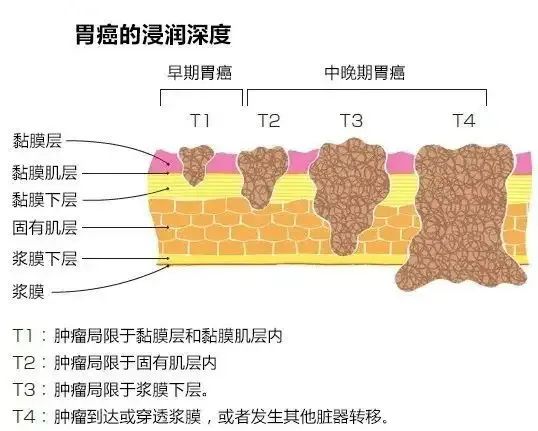 胃癌存活率图片