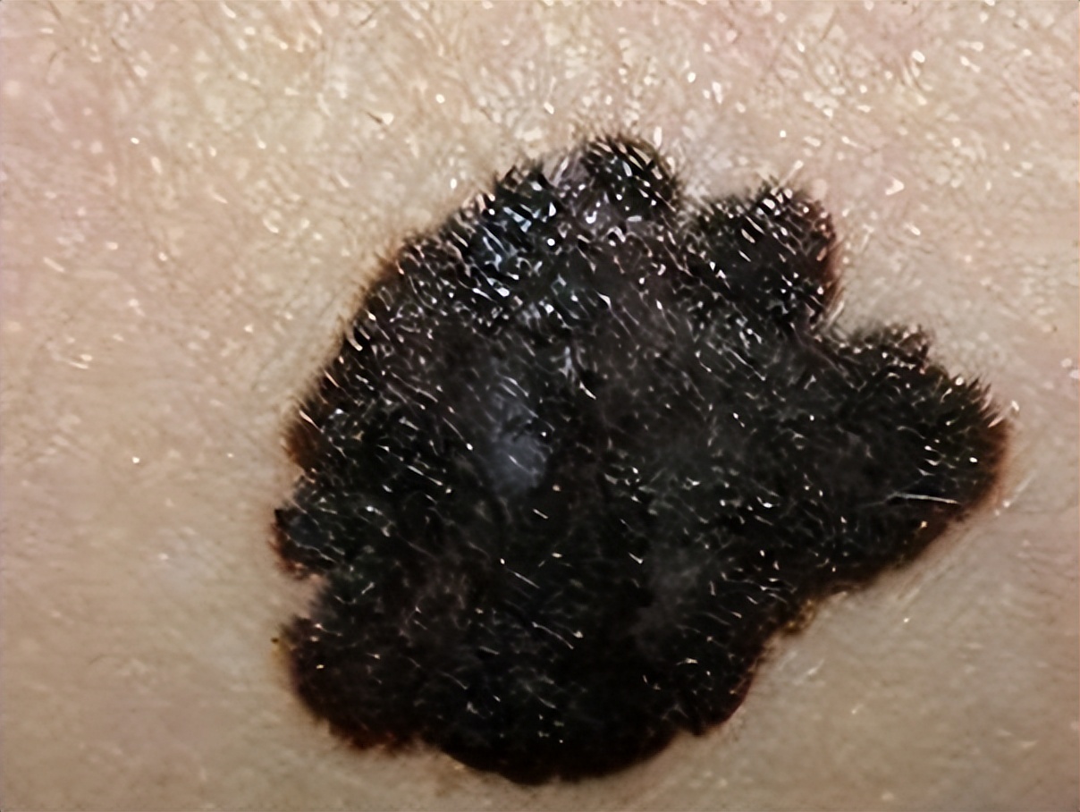 好声音张恒远因黑色素瘤去世,黑色素瘤到底长什么样?该如何治疗