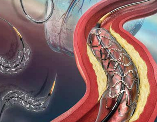 刘建钢教授:支架搭桥前先试下"臭氧"治疗