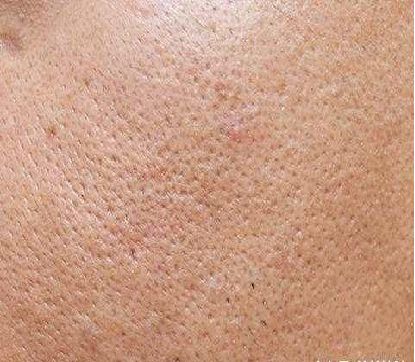 毛孔管理丨毛孔粗大原来也分类型,对症下药才能轻松0毛孔!