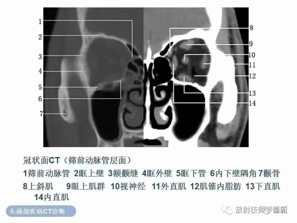 眼眶ct扫描技术