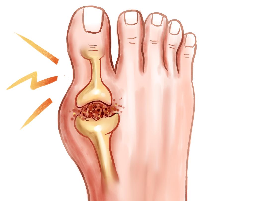 导致身体免疫系统过度反应而造成的炎症,一般发作部位为大拇指关节,踝