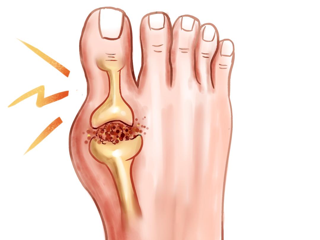 痛风了,要怎么办?