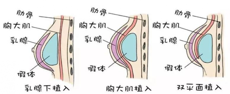 假體材料豐乳,有效改善胸部形態,但要注重術後規範護理