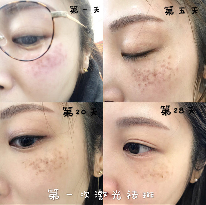 有些食物会导致黄褐斑?激光祛斑效果好吗?