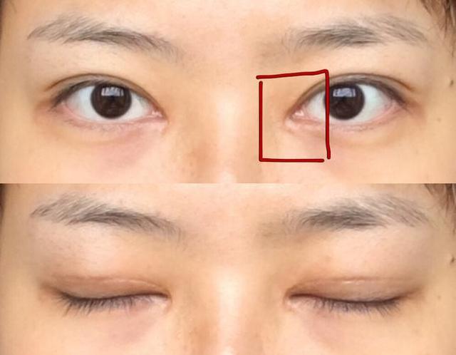 开眼角手术可以使眼睛变大,魅力倍增,但也有术后留下疤痕的风险