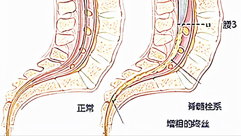 孩子得了脊髓栓系综合征,身体可能会有所提示,家长们应该注意