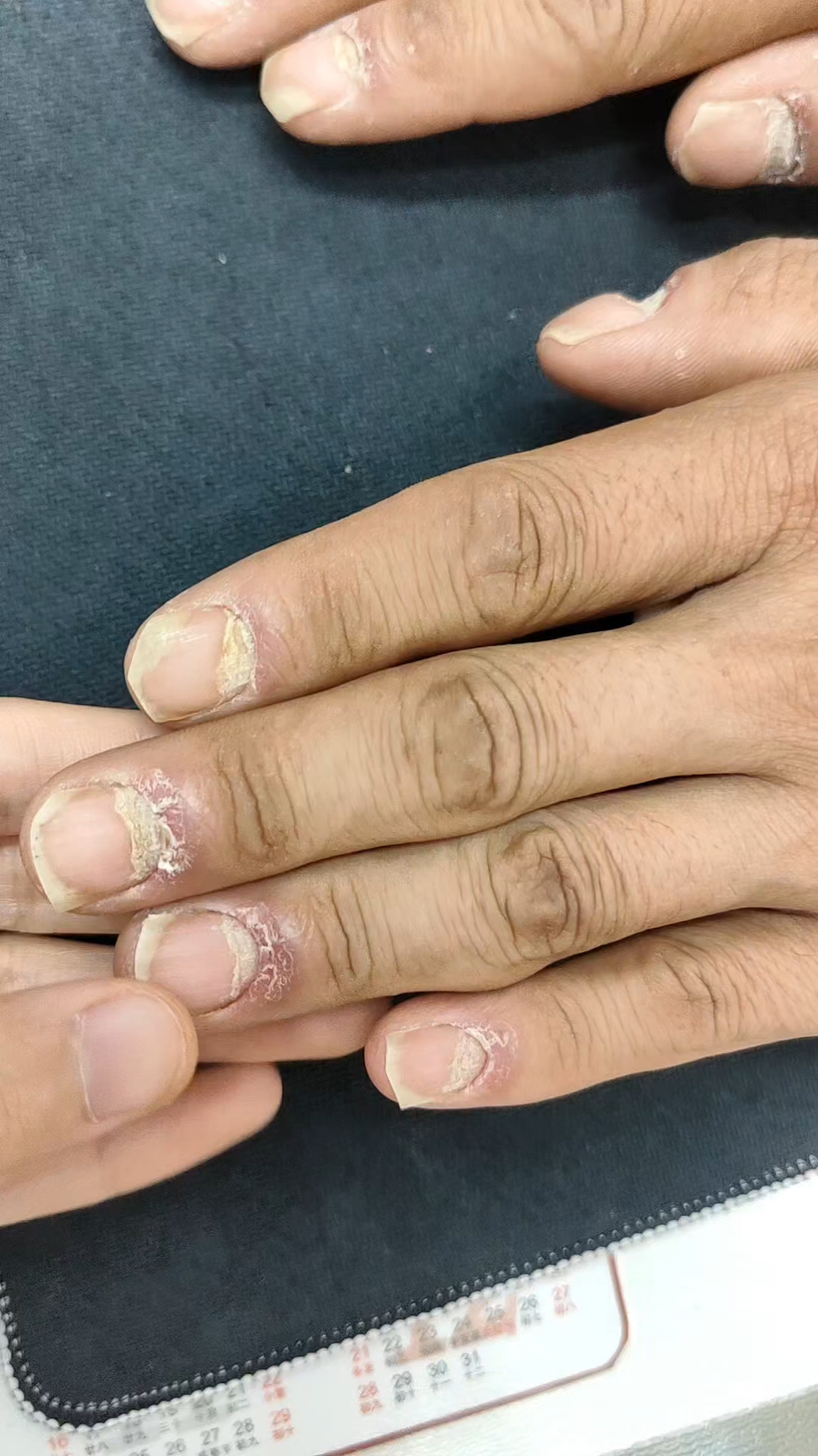 容易被误诊的银屑病甲!#邯郸中杰皮肤科刘晗阳医生