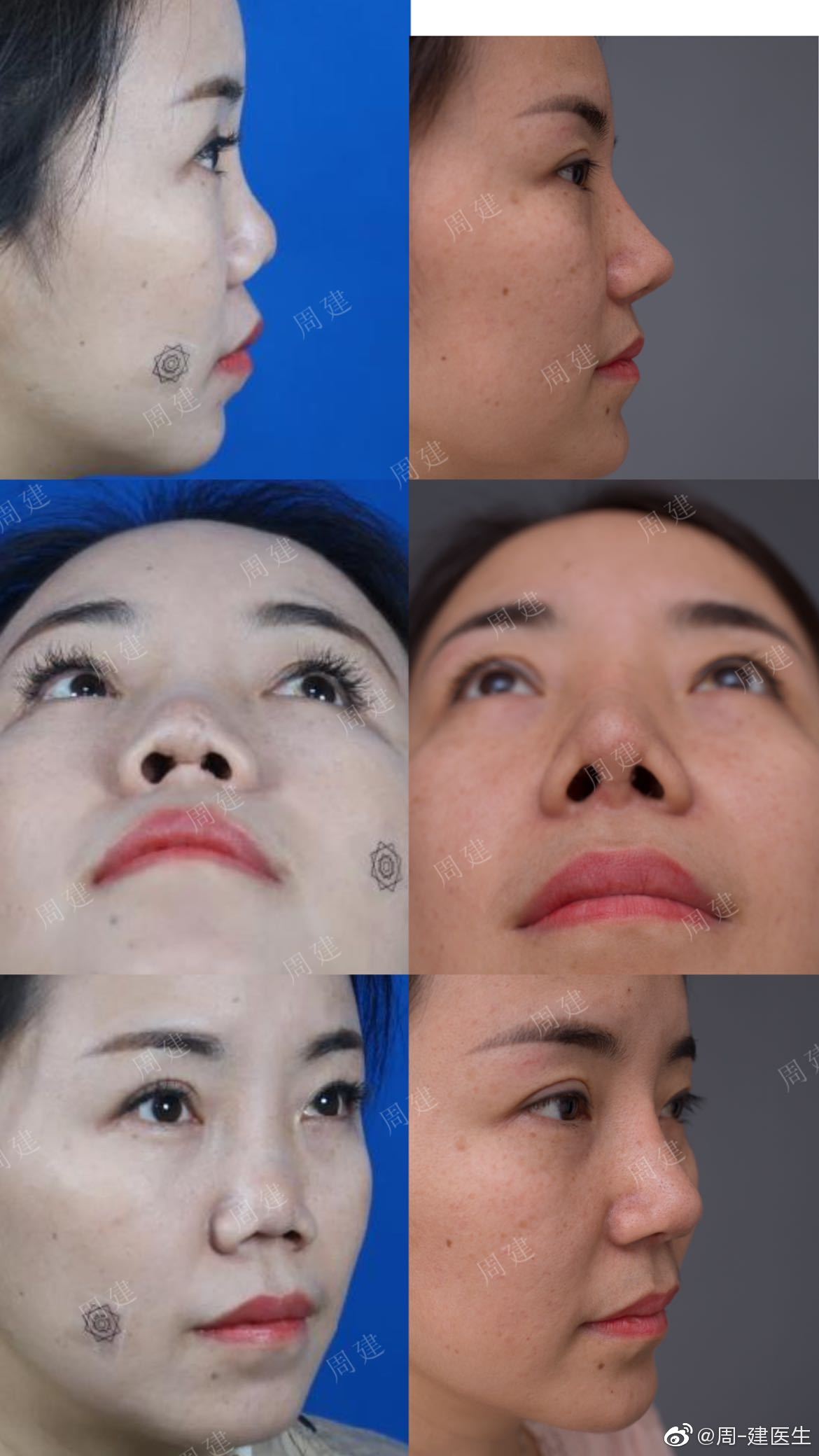 哑铃鼻基底,新术式不移位,郑州周建医生鼻整形专访