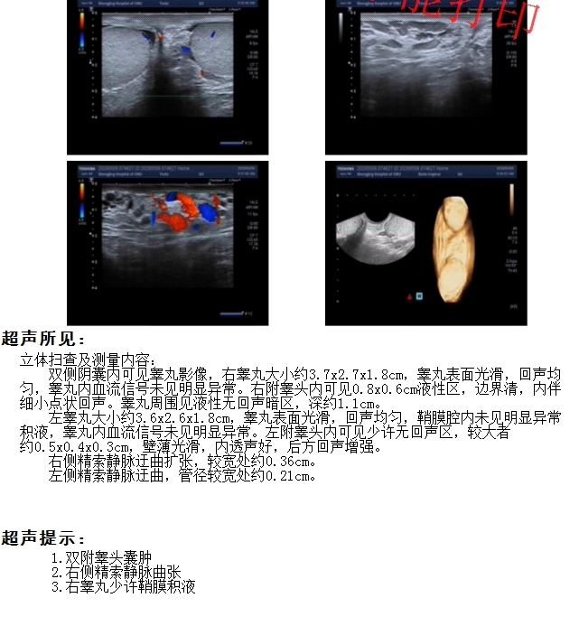 精索静脉曲张到底需不需要手术?