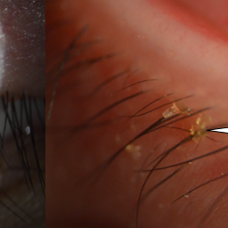 半年内反复眼痒,眼屎增多,17岁男生睫毛根部"找"出12只虫子