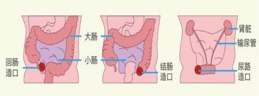 回肠造口位置图片