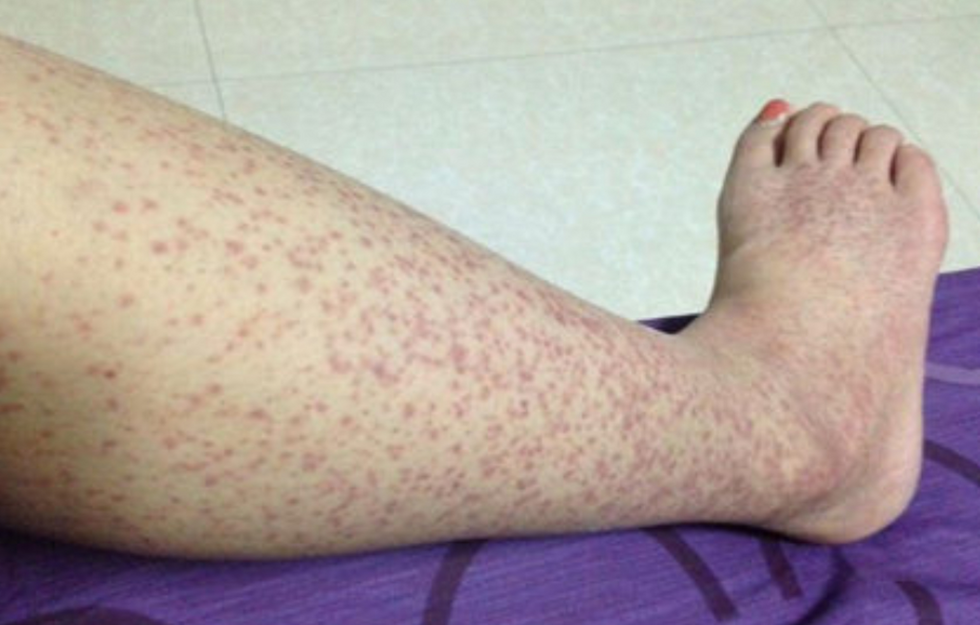 26岁女子,刚结婚一个月,皮肤上长满了小红点 ,嘴里有血疱,来医院看病.