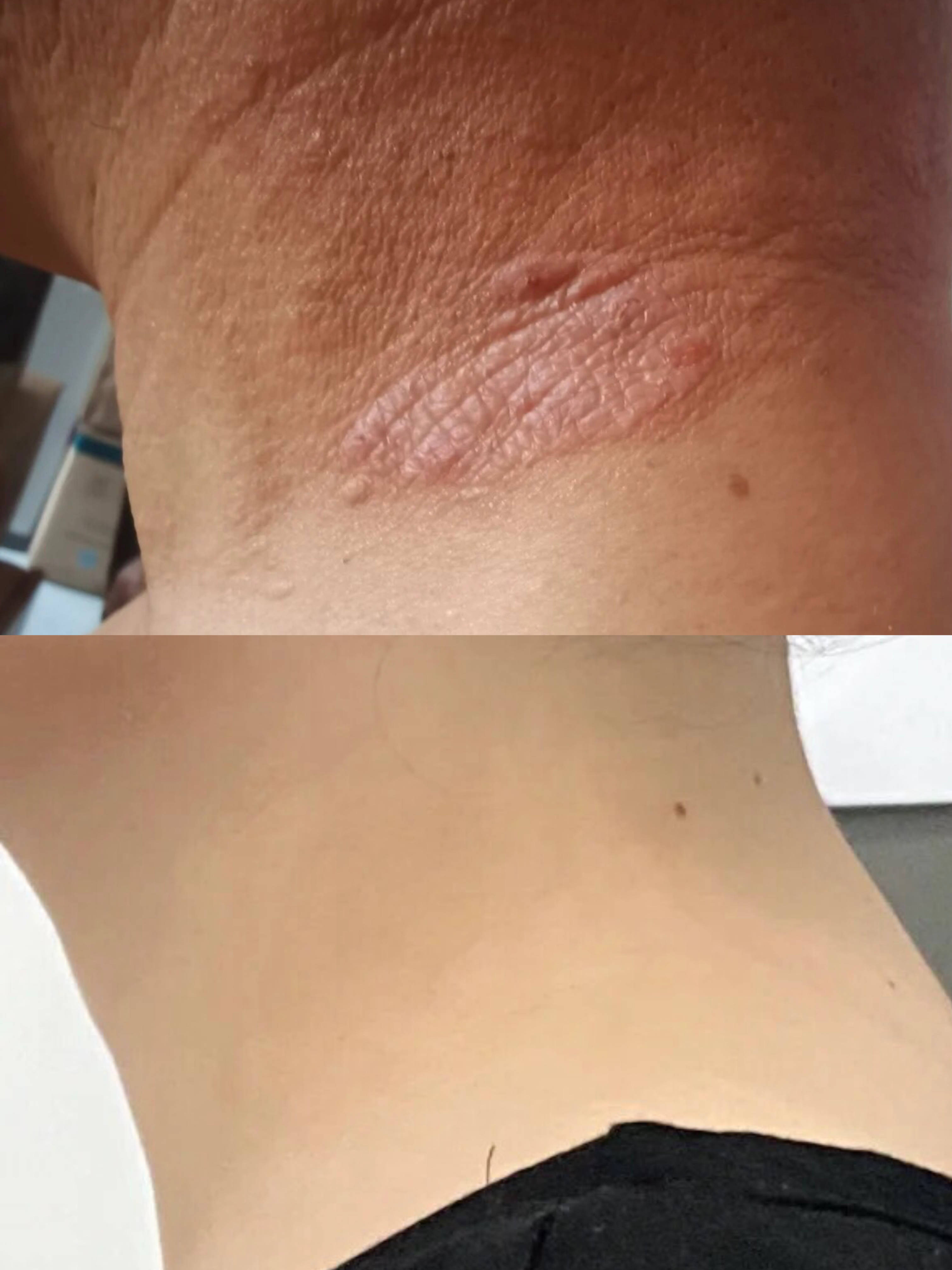 皮肤增厚,瘙痒不止?过来人教你轻松解决小妙招,皮炎几天就恢复