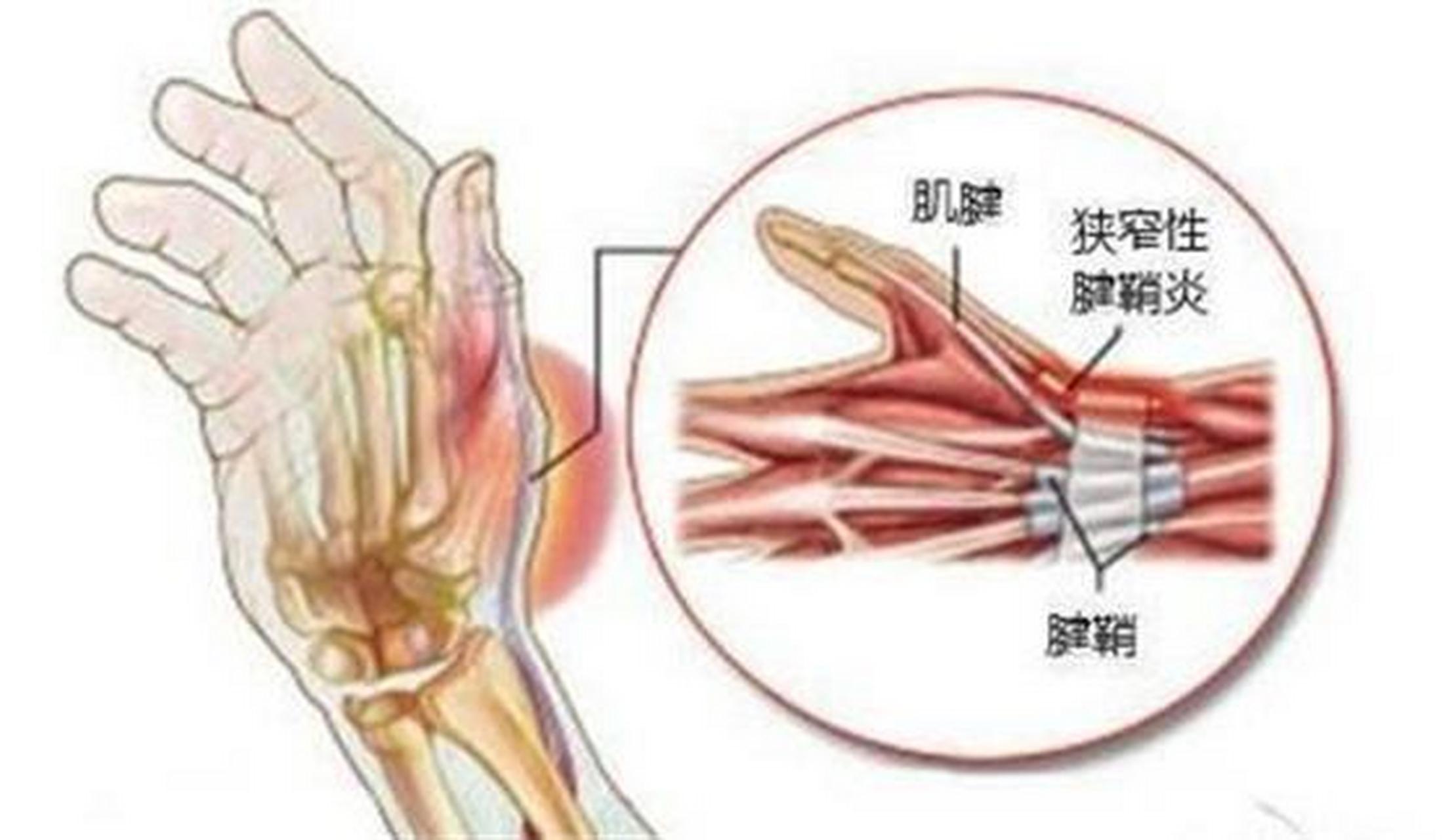 腱鞘炎怎么根除?睡前做好这几件事,方便且有效!