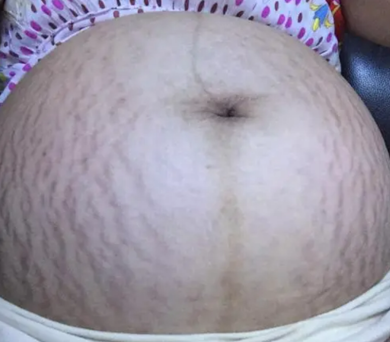 8个月孕妇抱着西瓜拍孕妇照,看到"西瓜纹"的肚皮,丈夫沉默了